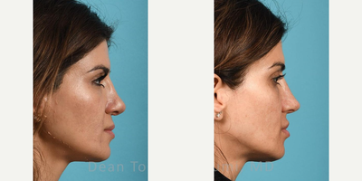 Revision Rhinoplasty before and after photo