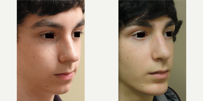 Chin Implant before and after photo
