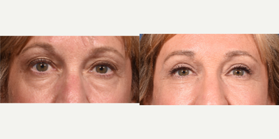 Eyelid Surgery before and after photo