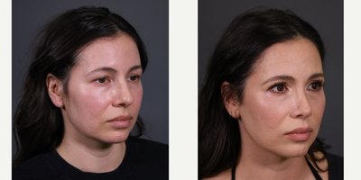 Eyelid Surgery before and after photo