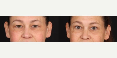 Eyelid Surgery before and after photo