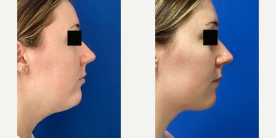 Liposuction before and after photo