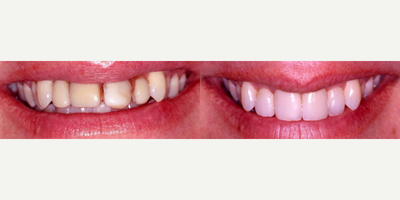 Porcelain Veneers before and after photo