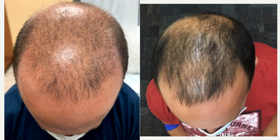 PRP for Hair Loss before and after photo
