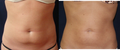 Smart Lipo before and after photo