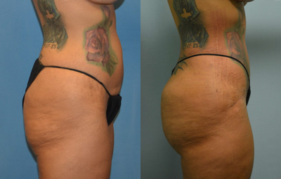 Tummy Tuck before and after photo