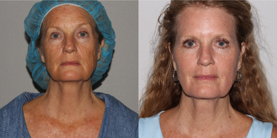 ActiveFX before and after photo