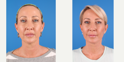 Chin Implant before and after photo