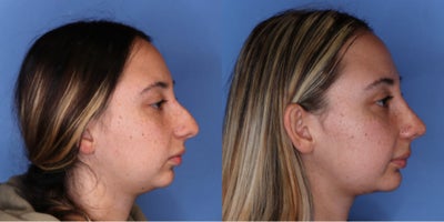 Rhinoplasty before and after photo