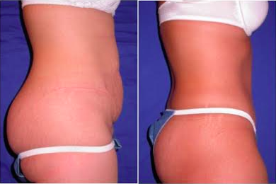 Tummy Tuck before and after photo