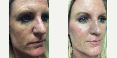 Dermal Fillers before and after photo