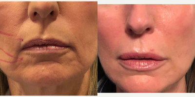 Dermal Fillers before and after photo