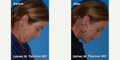 Facelift before and after photo