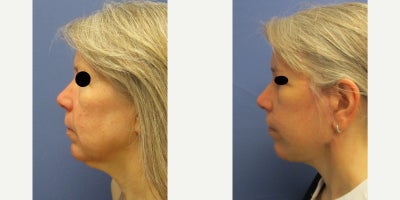 Neck Lift before and after photo
