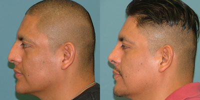 Rhinoplasty before and after photo