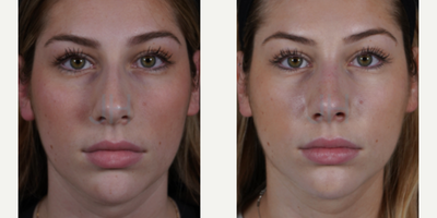 Rhinoplasty before and after photo