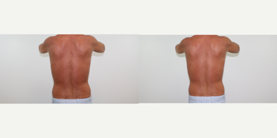 UltraShape Power before and after photo