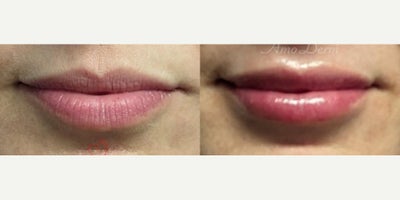 Volbella before and after photo