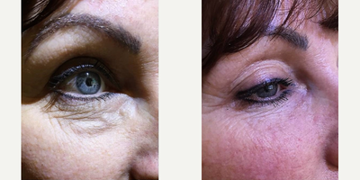 Dermal Fillers before and after photo
