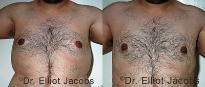 Gynecomastia Surgery before and after photo