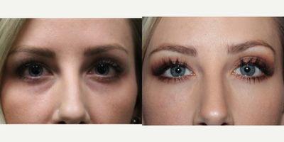 Restylane before and after photo