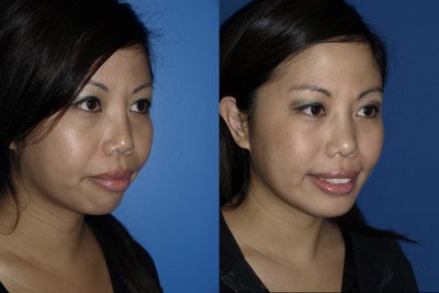 Revision Rhinoplasty before and after photo