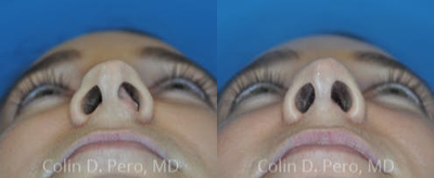 Rhinoplasty before and after photo
