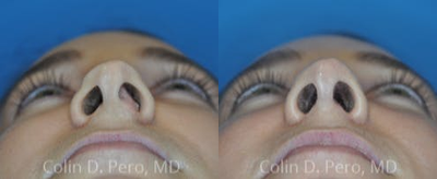Rhinoplasty before and after photo