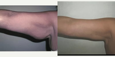 Arm Lift before and after photo