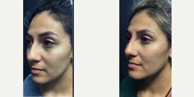 Bellafill before and after photo