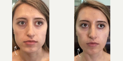 Botox before and after photo