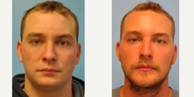 Chin Implant before and after photo