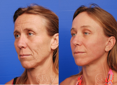 Facelift before and after photo