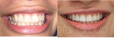 Invisalign before and after photo