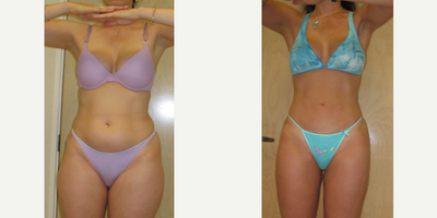 Laser Liposuction before and after photo