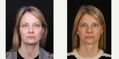 Neck Lift before and after photo