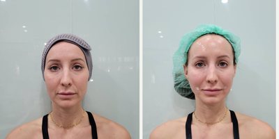 Restylane before and after photo