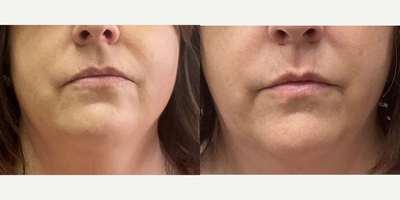 Botox before and after photo