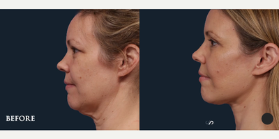 Eyelid Surgery before and after photo