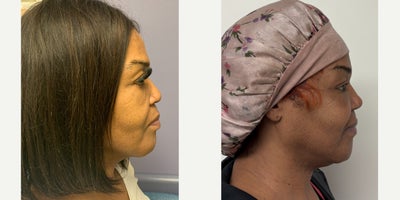 Facial Feminization Surgery before and after photo