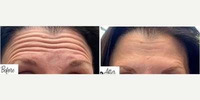 Botox before and after photo