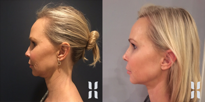 Dermal Fillers before and after photo