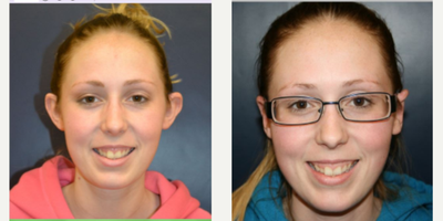 Ear Surgery before and after photo