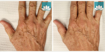 IPL before and after photo