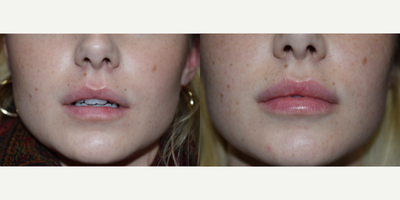 Lip Fillers before and after photo