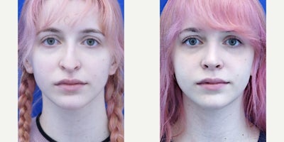 Revision Rhinoplasty before and after photo