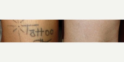 Tattoo Removal before and after photo