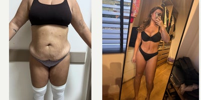 Tummy Tuck before and after photo