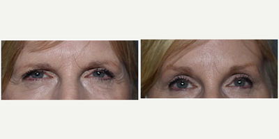 Brow Lift before and after photo