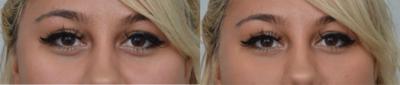 Dermal Fillers before and after photo